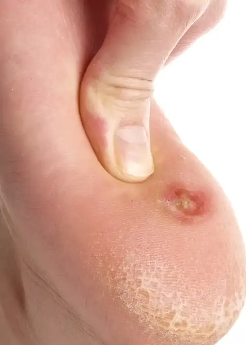 Calo Infeccionado