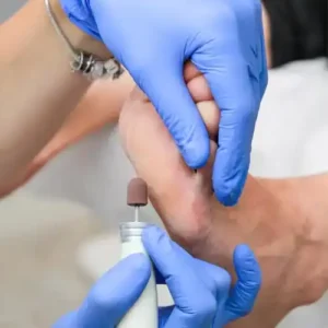 Pé diabético – como a podologia pode evitar complicações graves