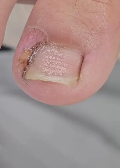 Unha Infeccionada